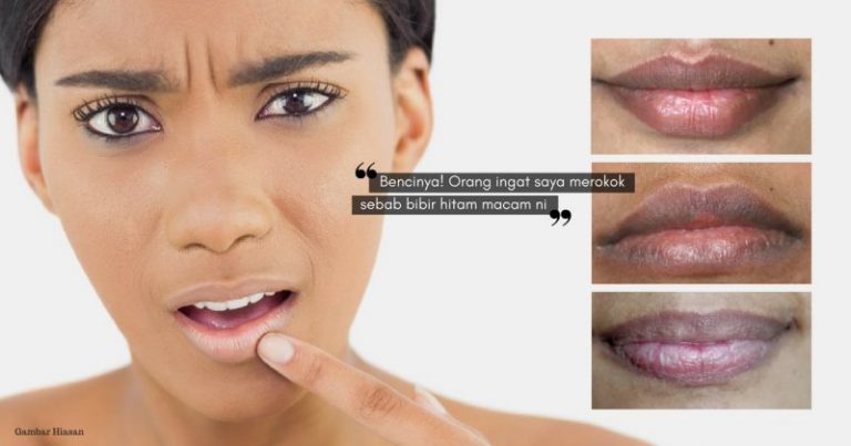 Hapuskan BIBIR HITAM & Dapatkan Senyuman Pink Jambu Dengan 8 Cara Mudah Ini