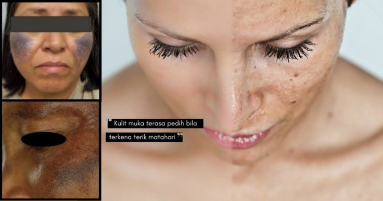 Awas, Obsesi Kulit Putih Gebu Boleh Mengundang HIPERPIGMENTASI & OCHRONOSIS! Check Label PRODUK PEMUTIH Anda Hari Ini